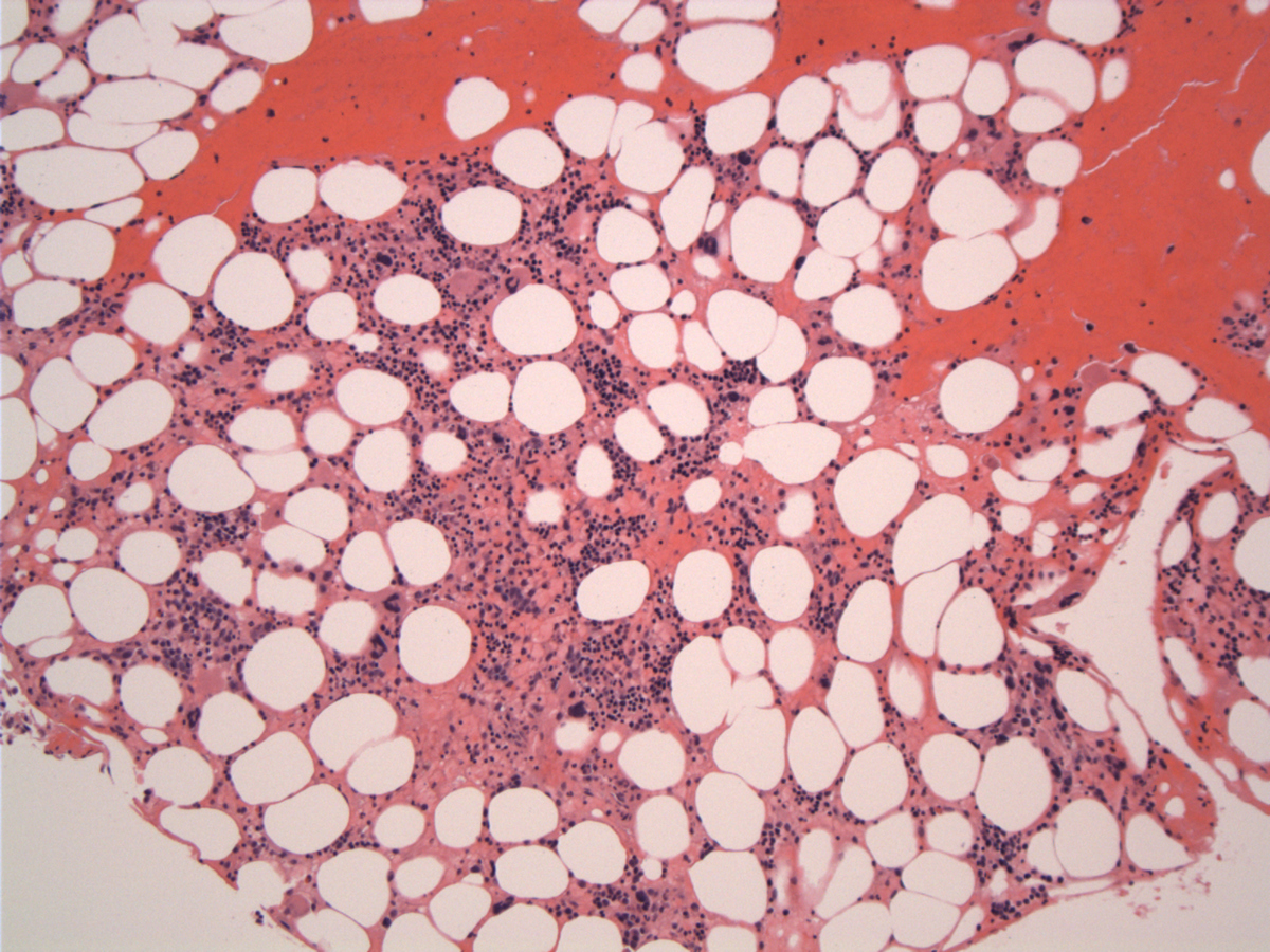 Bone marrow at presentation-day 1
